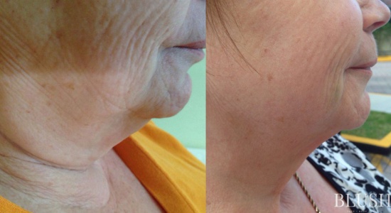 Laser Facelift