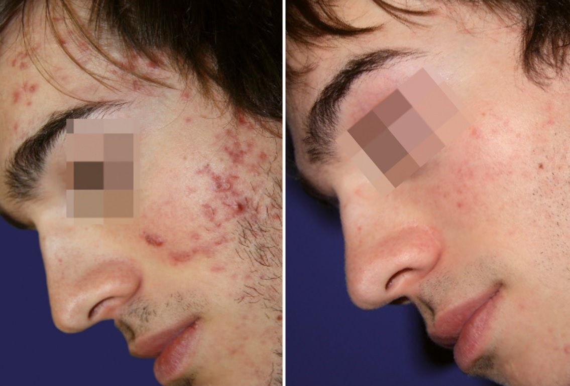 voor en na foto resultaat na acnelan kuur