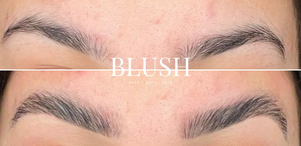 foto resultaten na een browlift